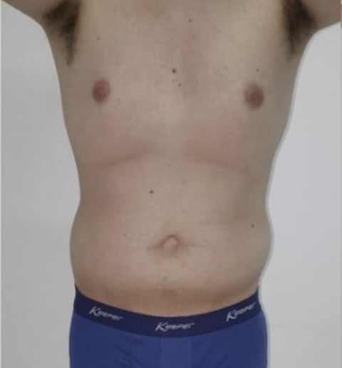 Abdominoplastia - Antes