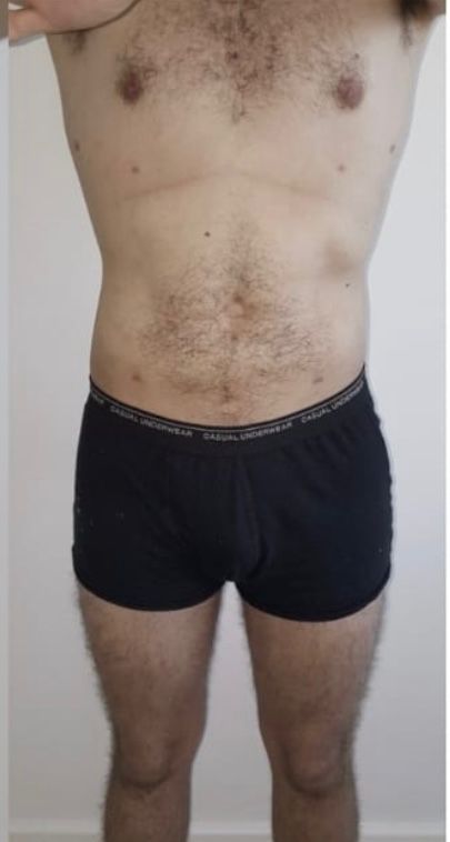 Abdominoplastia - Depois